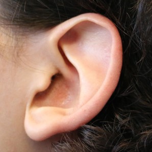 Left ear with absent antihelical fold.