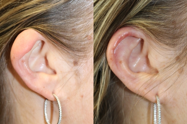 Lop ear otoplasty